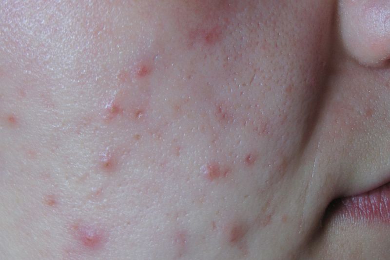 Acne behandeling bij Florin Beauty Salon in Ede