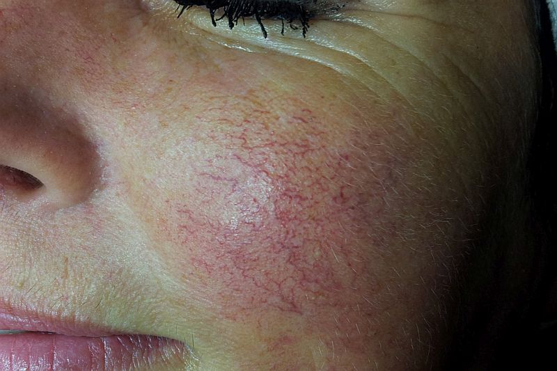 Couperose behandeling bij Florin Beauty Salon in Ede