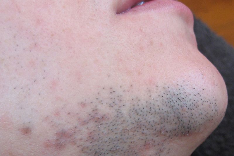 Definitief ontharen bij Florin Beauty Salon in Ede