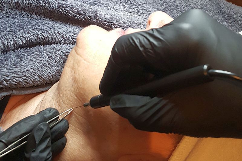 Huidoneffenheden verwijderen met de T-away bij Florin Beauty Salon in Ede