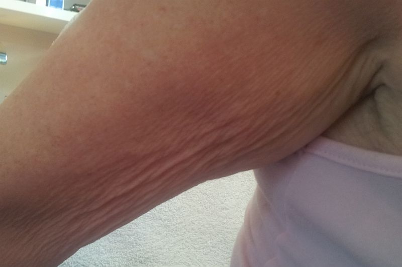 Huidverslapping door elastine verlies Florin Beauty Salon in Ede
