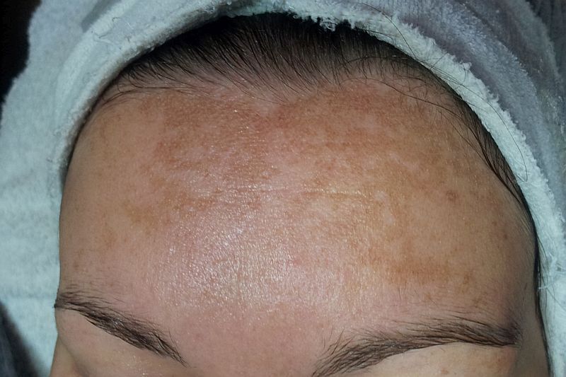 Pigmentvlekken verwijderen bij Florin Beauty Salon in Ede