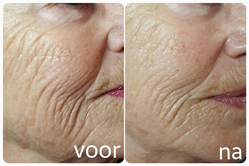 Resultaat Elastine Infusie Therapie bij Florin Beauty Salon in Ede