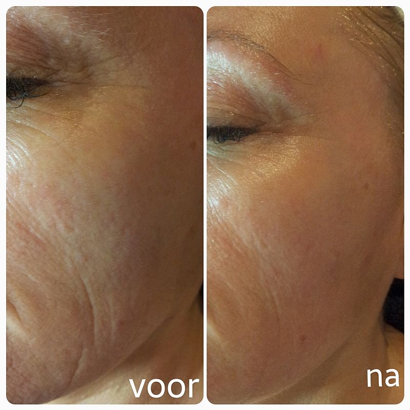 Resultaat huidverstrakking met de BTS-2 bij Florin Beauty Salon in Ede