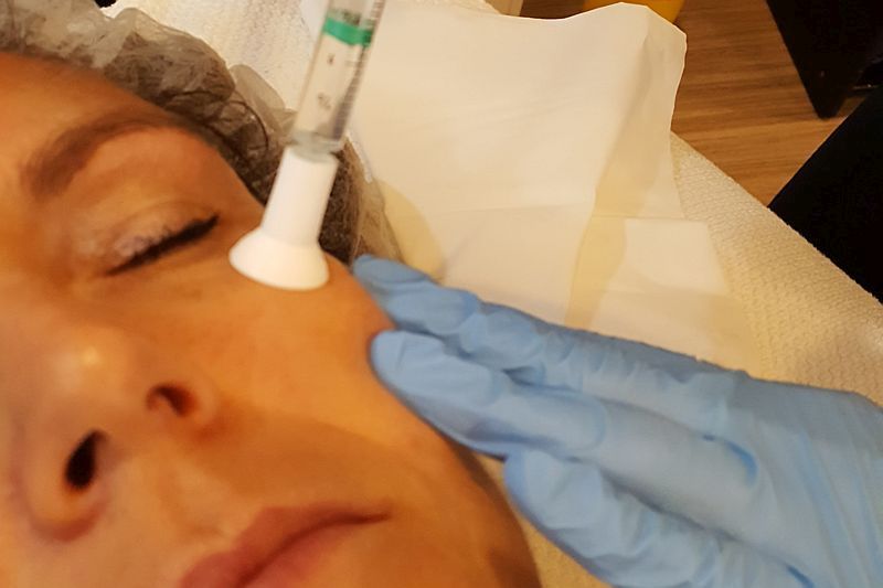 Micro-meso therapie bij Florin Beauty Salon in Ede